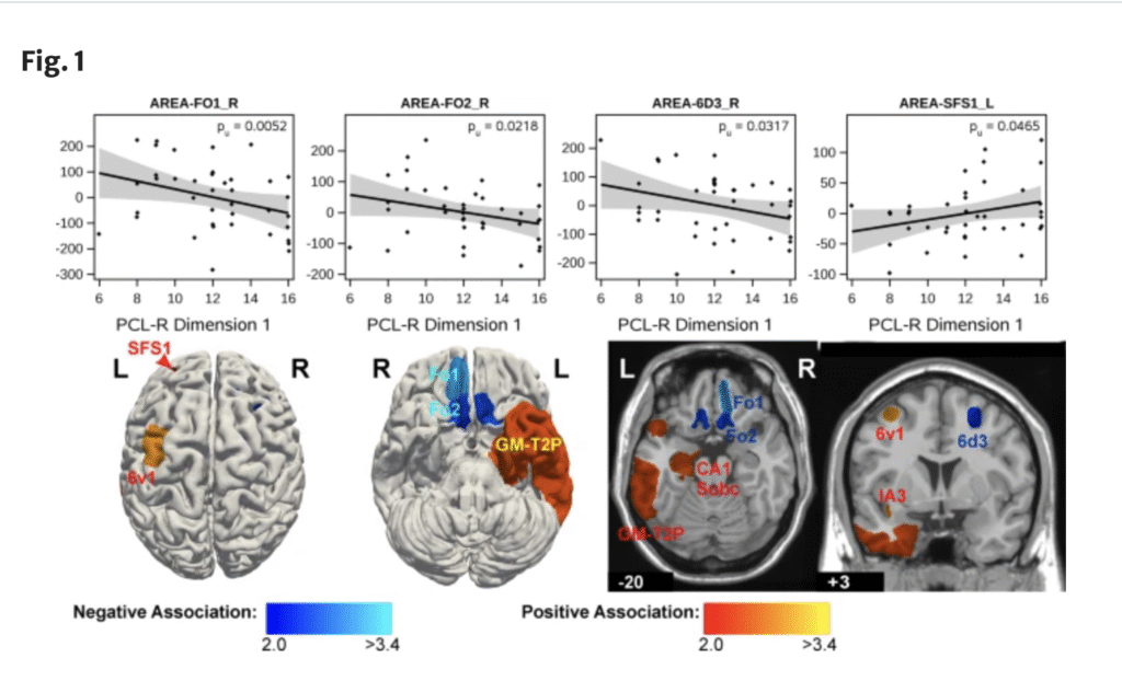 La imagen escalofriante del cerebro de un psicópata revelada por la ciencia.
